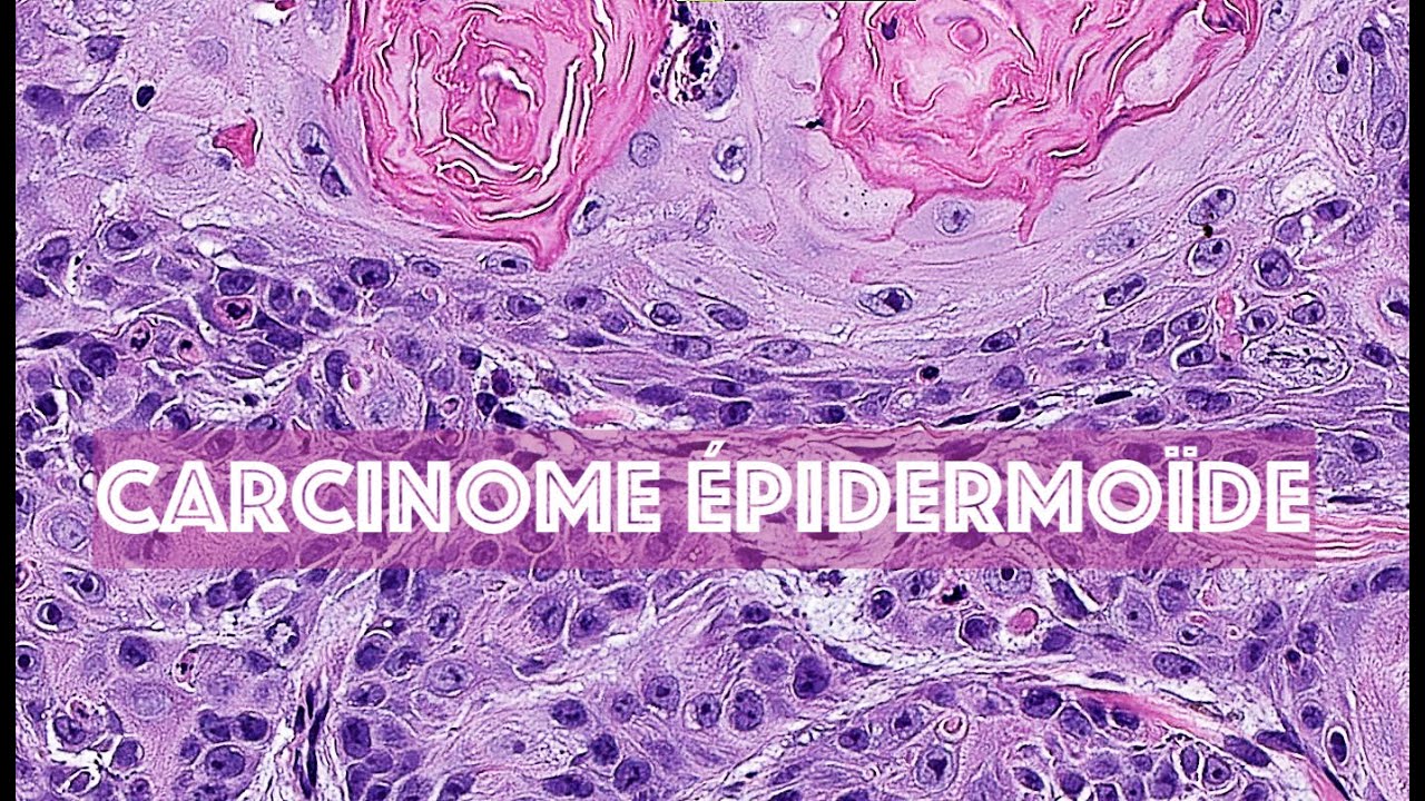 LE CARCINOME EPIDERMOÏDE CUTANE - PATHOLOGIE