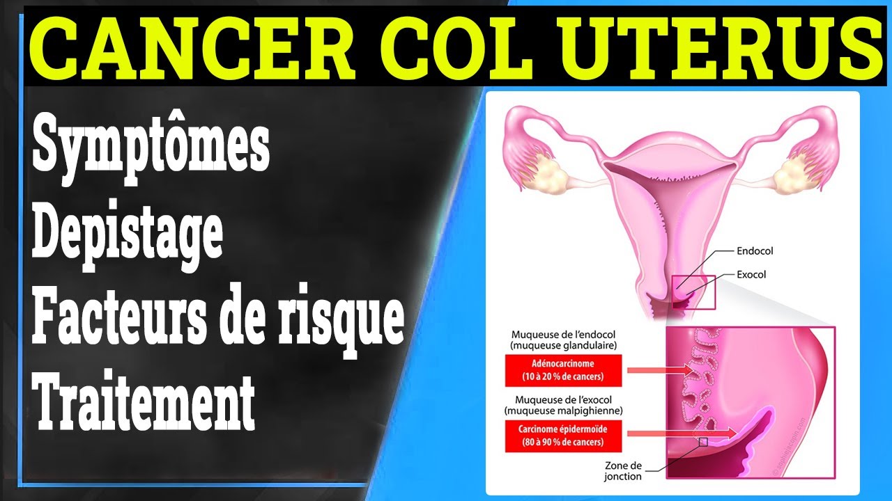 Cancer du Col de l'Utérus: Symptômes, Causes, Traitement | Gynécologie